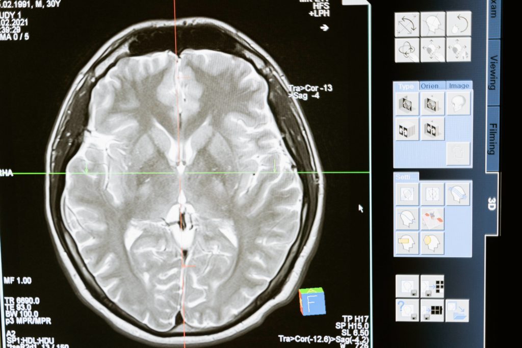 Imagem de um exame de um cérebro feito em um computador.